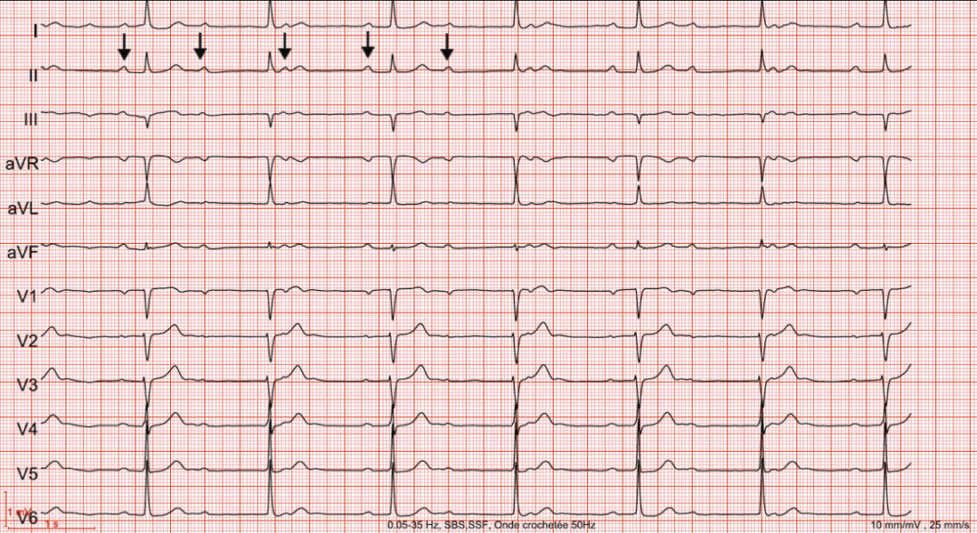 ECG syndrome du QT long - Rythmopôle Paris - Allongement intervalle QT diagnostic