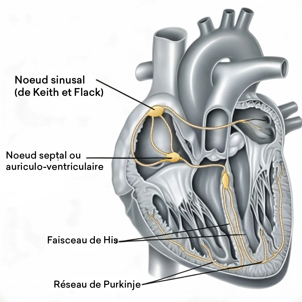 Illustration du système de conduction cardiaque montrant le nœud sinusal, le nœud auriculo-ventriculaire, le faisceau de His et le réseau de Purkinje, structures impliquées dans le bloc de branche gauche.